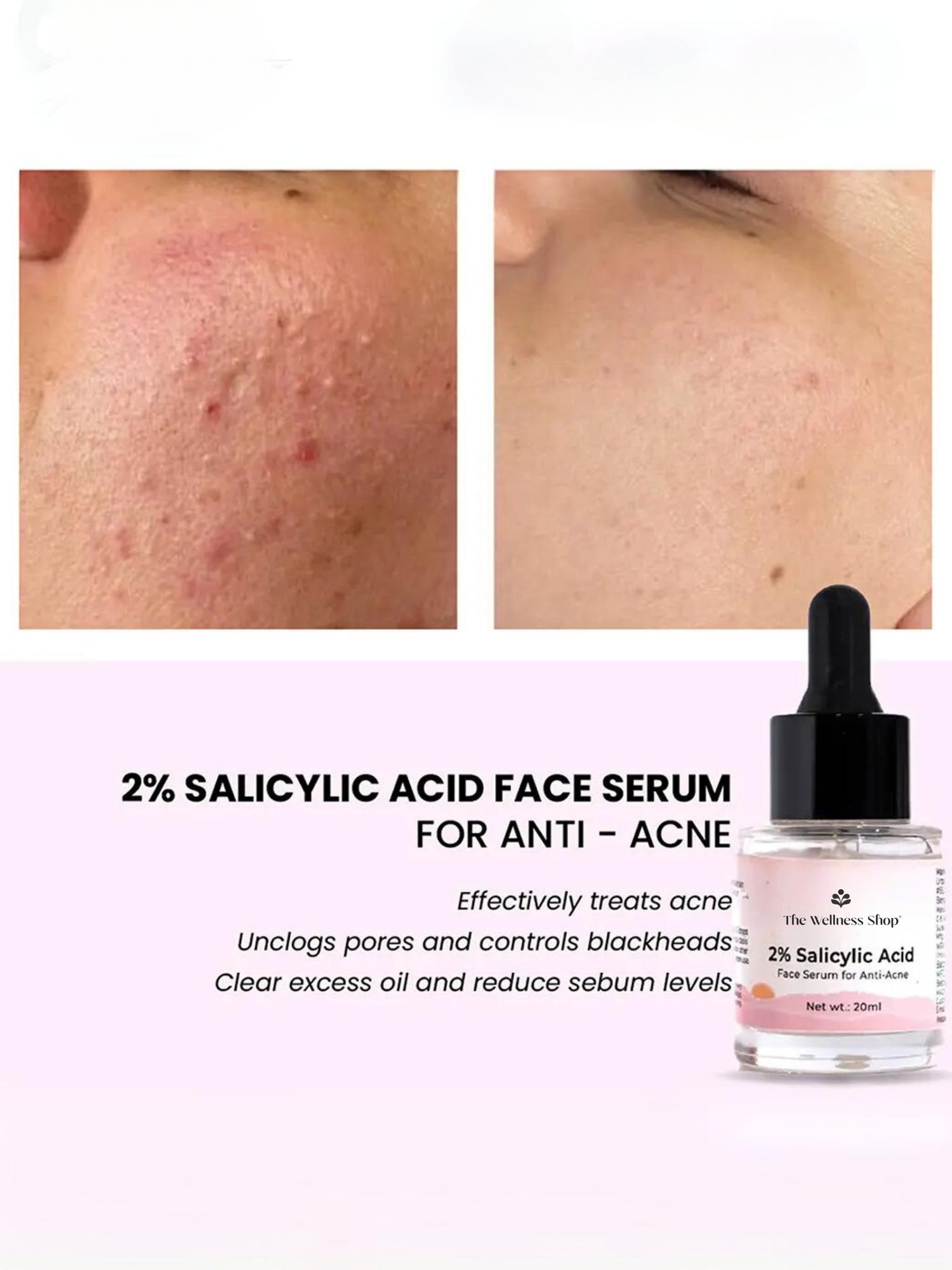 2% SALICYLIC ACID : FACE SERUM FOR ANTI - ACNE