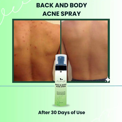 BACK AND BODY ACNE SPRAY (ACNE CONTROL, AVOIDS ACNE BREAKOUTS, ORGANIC INGREDIENTS)